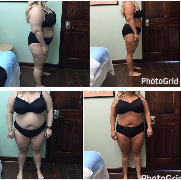 Losing Losing Weight Success Stories: Inspiring Transformations to Motivate You