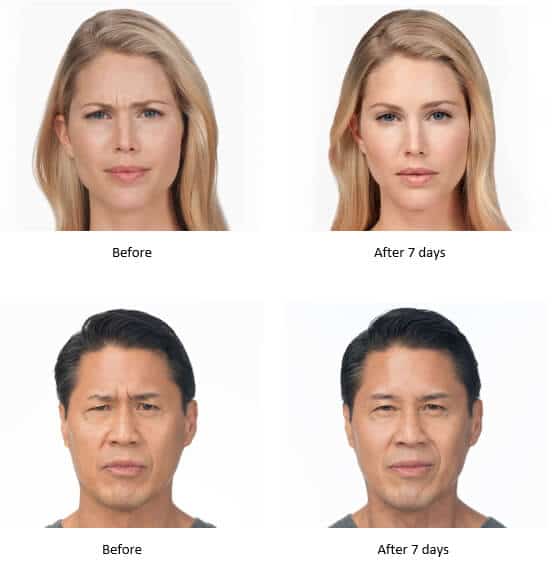 botox treatment before and after images