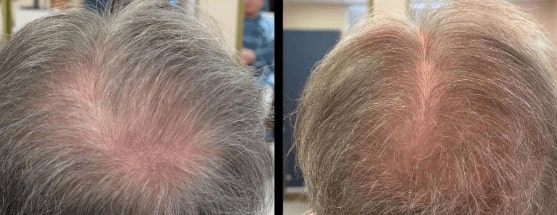 back of man's head with bald spot, next to same man's head without bald spot, example of potential hair restoration treatment results.