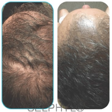 back of balding man's head, next to same man's head with fuller hair, example of potential hair restoration treatment results.
