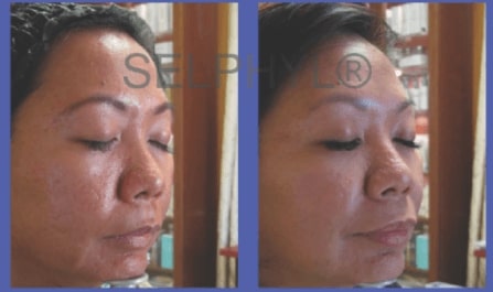 Before and After Stretch Mark and Scar Reduction in Lincoln Park IL