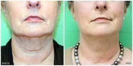 Before and After Exilis Elite Skin Tightening in Chicago IL