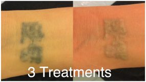 Before and After Tattoo Removal Treatment in Lincoln Park IL