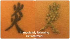 Before and After Tattoo Removal Surgery in Lincoln Park IL