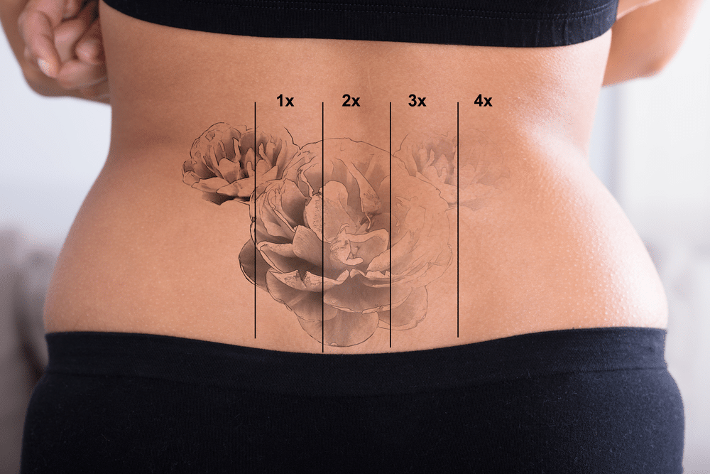 how long does the tattoo removal process take 62616c317ae1b