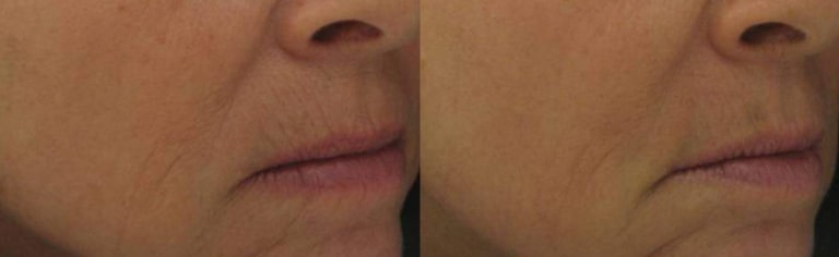 Before and After Laser Skin Resurfacing in Chicago IL
