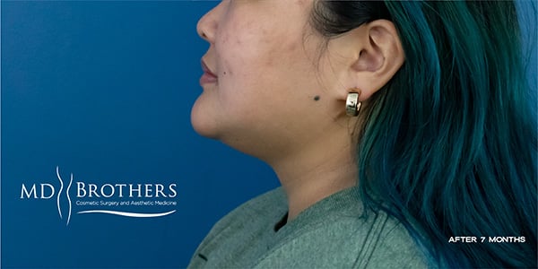 After Image: Chin Liposuction - front