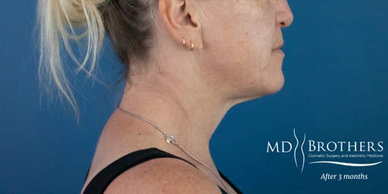 Before Image: Chin Liposuction - right-side