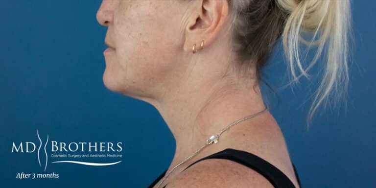 Before Image: Chin Liposuction - left-side