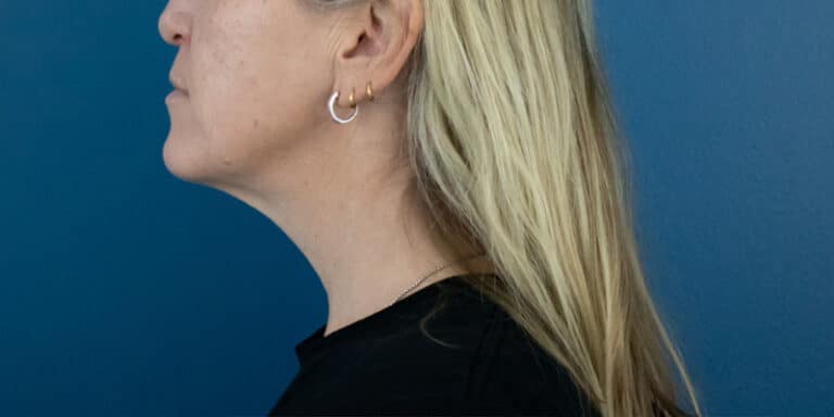 After Image: Chin Liposuction - left-side