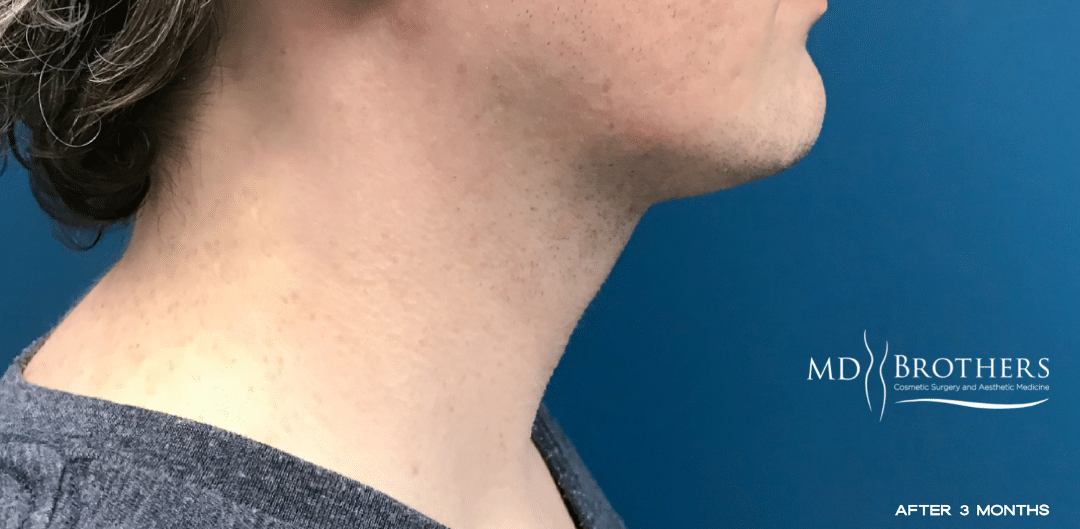 After Image: Chin Liposuction - right-side