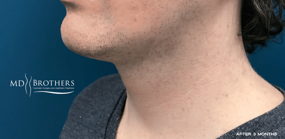 After Image: Chin Liposuction - left-front-oblique