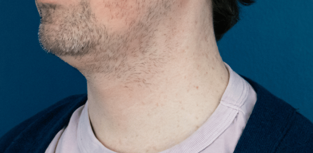 Before Image: Chin Liposuction - left-front-oblique