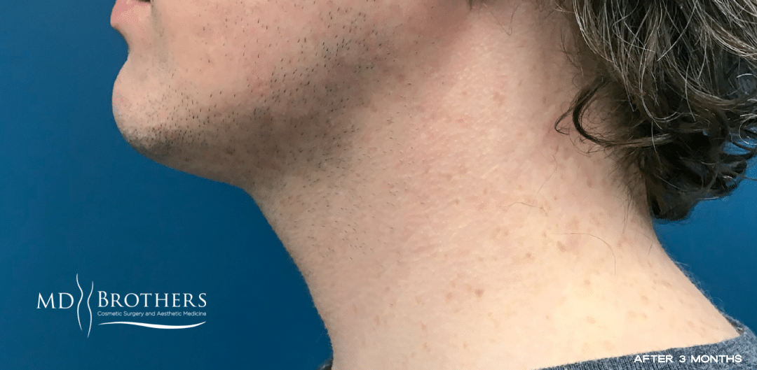 After Image: Chin Liposuction - left-side