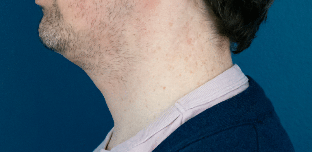 Before Image: Chin Liposuction - left-side