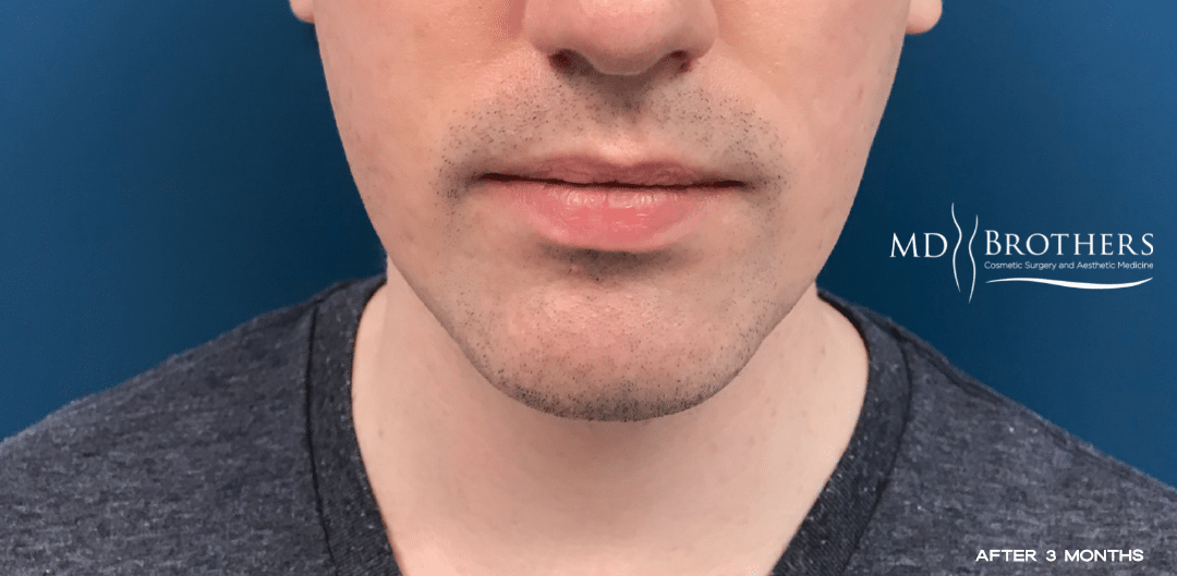 After Image: Chin Liposuction - front