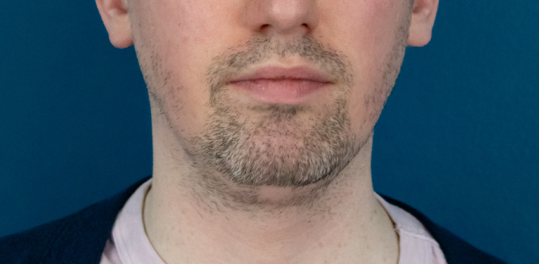 Before Image: Chin Liposuction - front