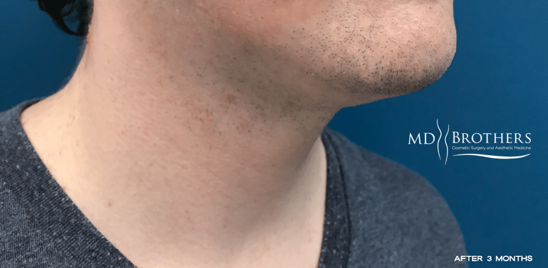 After Image: Chin Liposuction - right-front-oblique