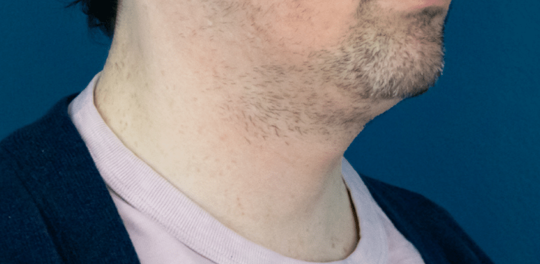 Before Image: Chin Liposuction - right-front-oblique