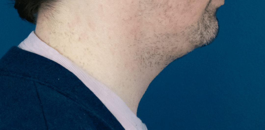 Before Image: Chin Liposuction - right-side