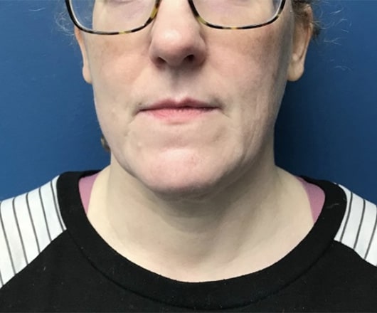 After Image: Chin Liposuction - front