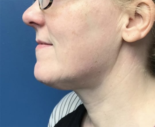 After Image: Chin Liposuction - front