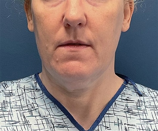 Before Image: Chin Liposuction - front