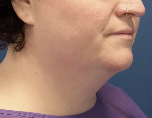 Before Image: Chin Liposuction - right-front-oblique