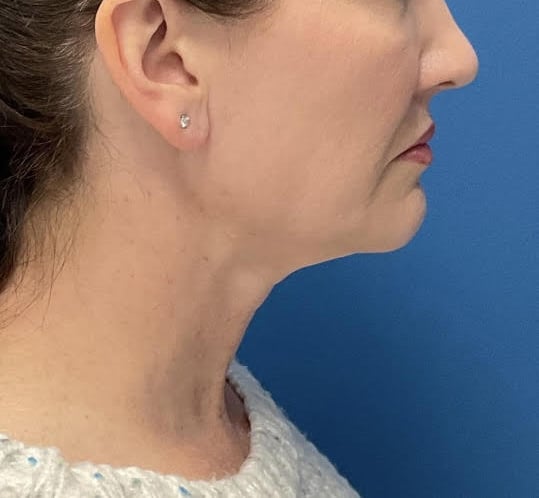 After Image: Chin Liposuction - right-side