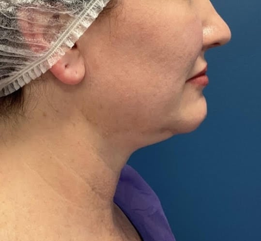 Before Image: Chin Liposuction - right-side