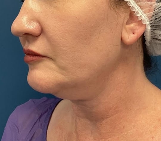 Before Image: Chin Liposuction - left-front-oblique