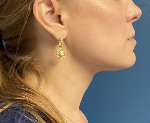 After Image: Chin Liposuction - right-side