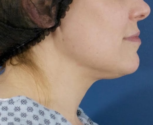 Before Image: Chin Liposuction - right-side