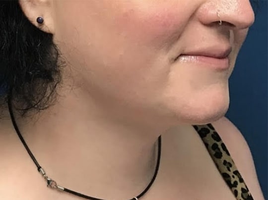 After Image: Chin Liposuction - right-front-oblique