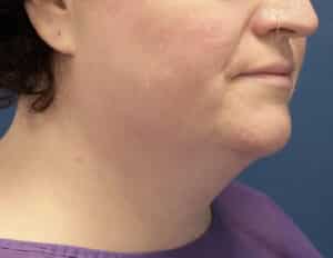 Before Image: Chin Liposuction