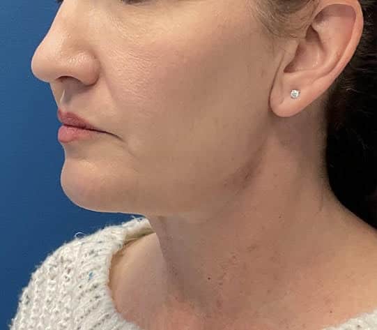 After Image: Chin Liposuction - left-front-oblique