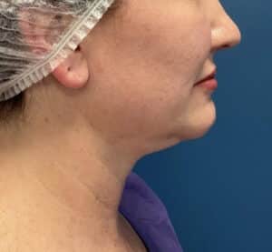 Chin Liposuction