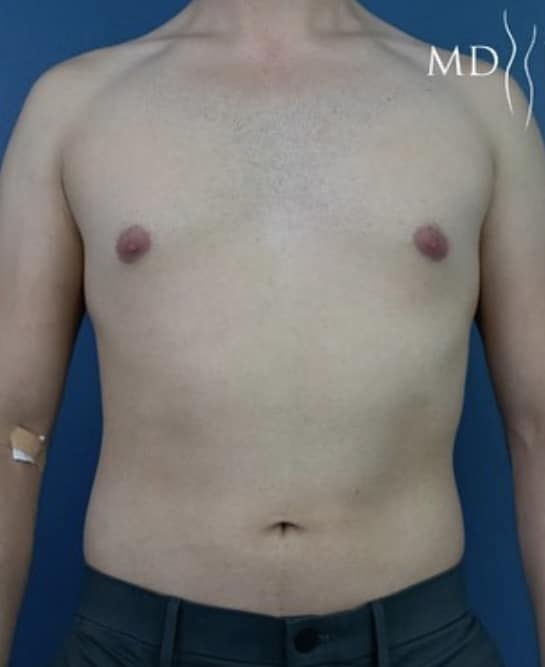 Before Image: Liposuction - front