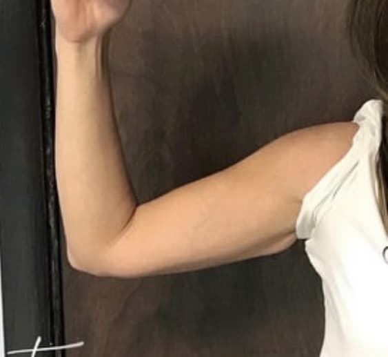 After Image: Arm Liposuction - front