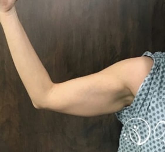 Before Image: Arm Liposuction - front