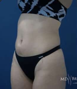 Before Image: Liposuction
