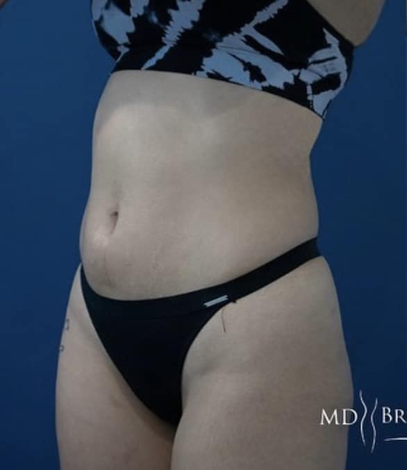 Before Image: Liposuction - left-front-oblique