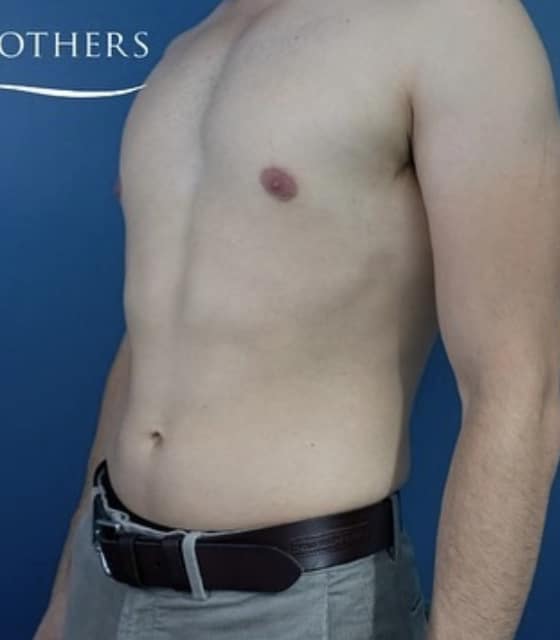 After Image: Liposuction - left-front-oblique