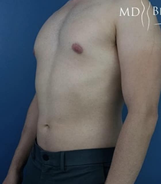 Before Image: Liposuction - left-front-oblique