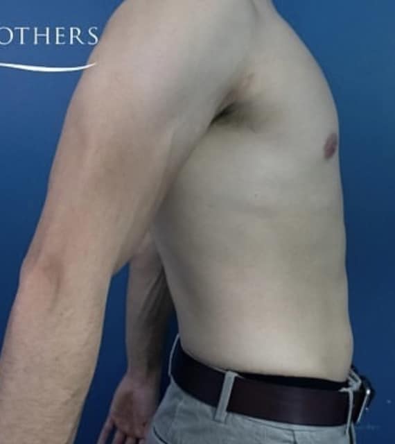 After Image: Liposuction - right-side