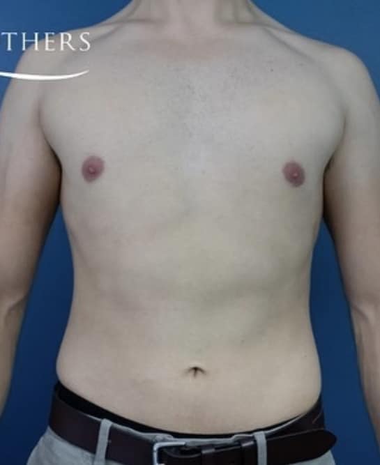 After Image: Liposuction - front