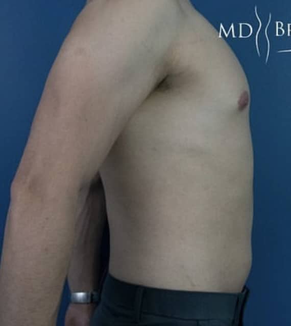 Before Image: Liposuction - right-side