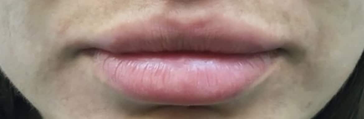 After Image: Lip Augmentation - front