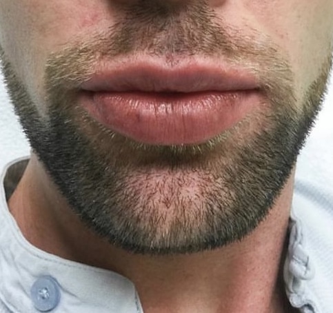After Image: Lip Augmentation - front