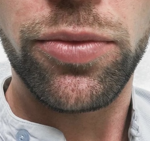 Before Image: Lip Augmentation - front